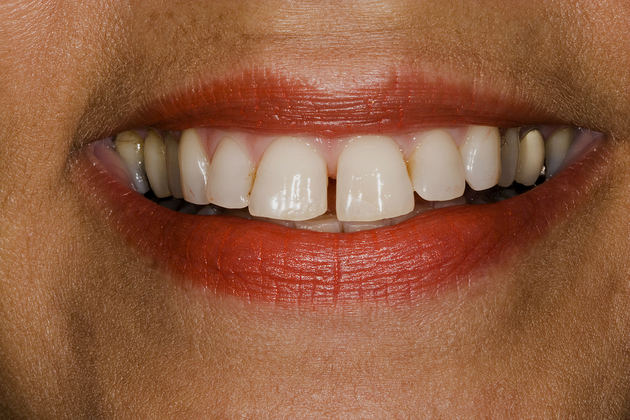 Nick Pournaras's patient before veneers