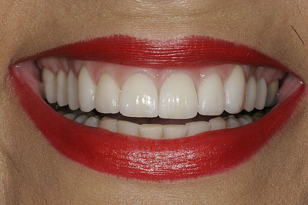 Nick Pournaras's patient after veneers